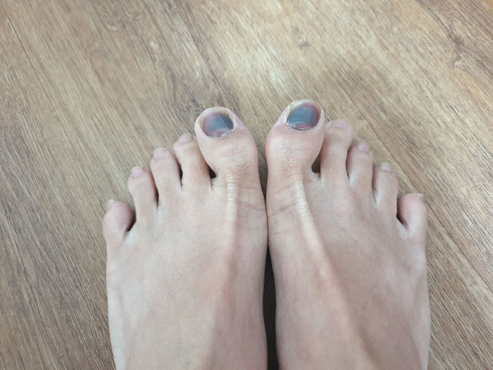 bruised-toes bruised-toes